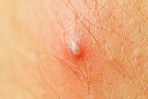 Безопасные способы борьбы с вросшими волосками после эпиляции